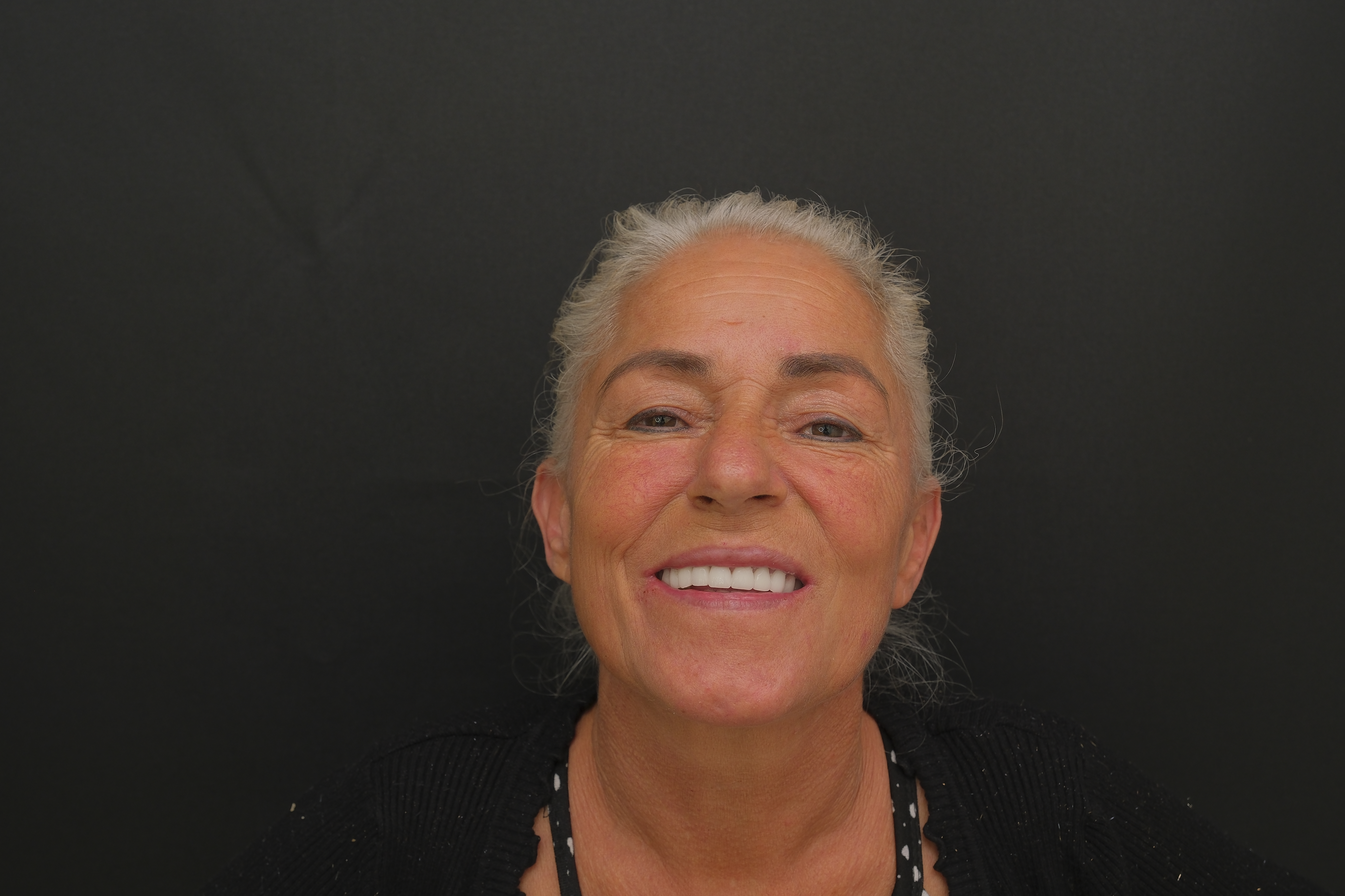 "After dental treatment at Eva Clinic Istanbul – 82-year-old woman with restored smile and improved oral health"