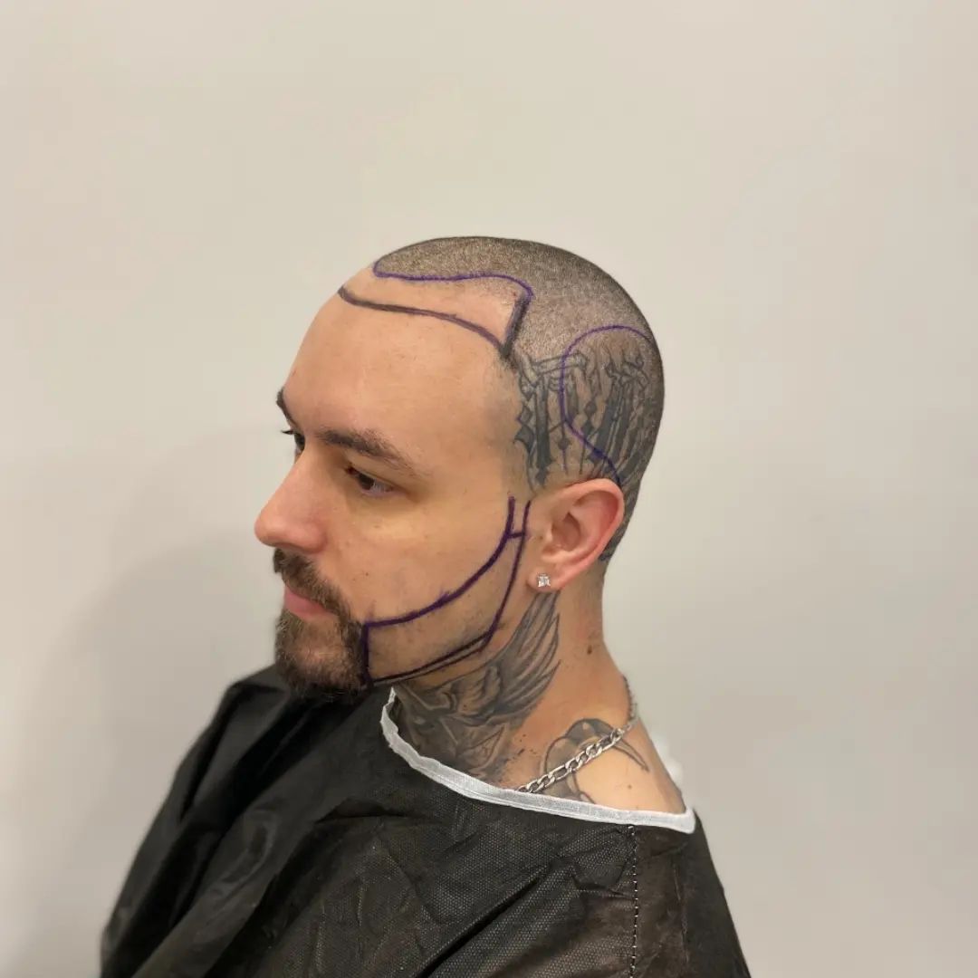 "Before and after results of a beard transplant at Eva Clinic Istanbul – natural-looking facial hair restoration in Turkey"